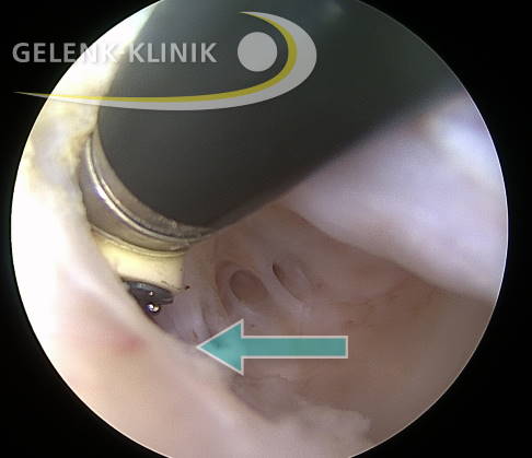 Arthroskopie: Zustand vor endoskopisch durchgeführter Arthrolyse im Ellenbogengelenk. © Gelenk-Klinik Kamerabild vor Arthrolyse im Ellenbogengelenk