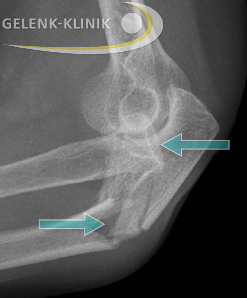 Verletzung des Ellenbogens mit Bruch der Elle und Luxation des Radiusköpfchens (Bado Typ 2)