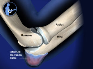 Schleimbeutelentzundung Am Ellenbogen Bursitis Olecrani Gelenk Klinik De