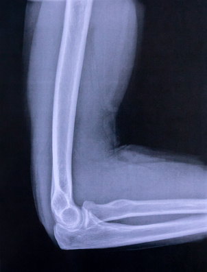 Röntgenbild eines gesunden Ellenbogens