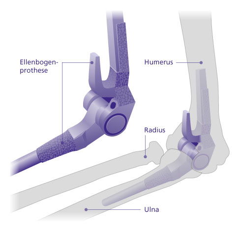 Aufbau einer Ellenbogenprothese