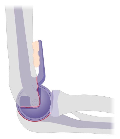 Schema Ellenbogenprothese seitlich