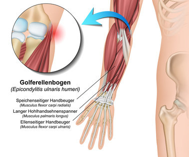 Anatomie der Ellenbogenmuskeln, deren Ansätze beim Golferellenbogen gereizt sind
