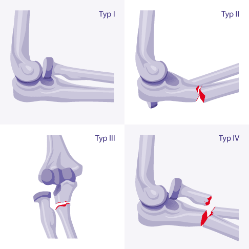 Klassifikation der Monteggia-Fraktur nach Bado