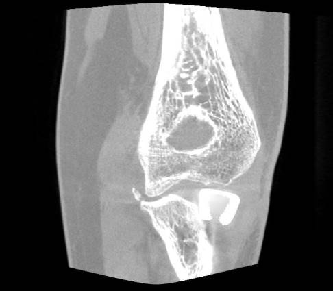 Radiuskopfchenfraktur Symptome Diagnose Und Behandlung Gelenk Klinik De