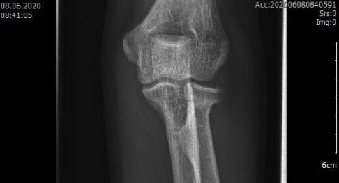 Röntgenbild: Ansicht von hinten auf das Ellenbogengelenk