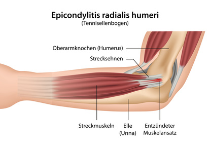 Beispiel einer RSI: Tennisarm