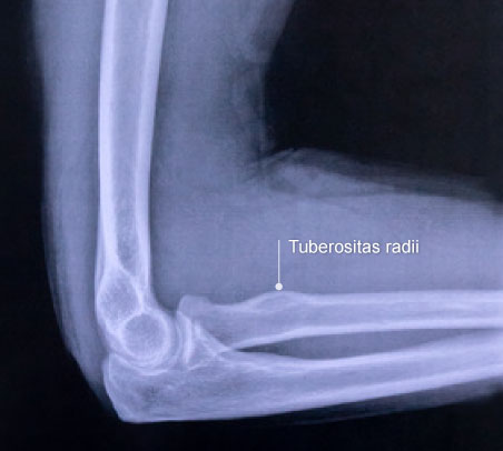 Das Röntgenbild zeigt die Aufrauhung am Speichenknochen, die sogenannte Speichenbeule. © Gelenk-Klinik Tuberositas radii