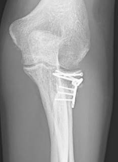 Лечение пациента с многооскольчатым переломом (Тип 3) после падения с горного велосипеда: Комбинированный остеосинтез с применением пластин с угловой стабильностью. Рентген показывает состояние сустава после заживления. 