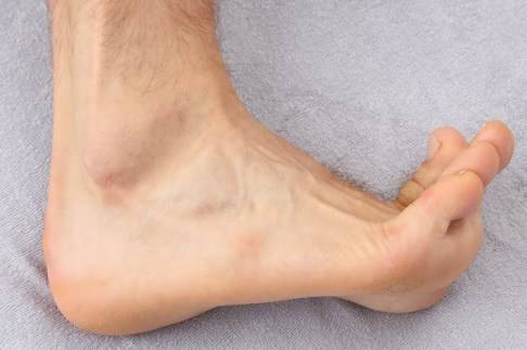 Die Dorsalextension – Anziehen der Zehen – kann den plantaren (fußsohlenseitigen) Fersenschmerz auslösen.