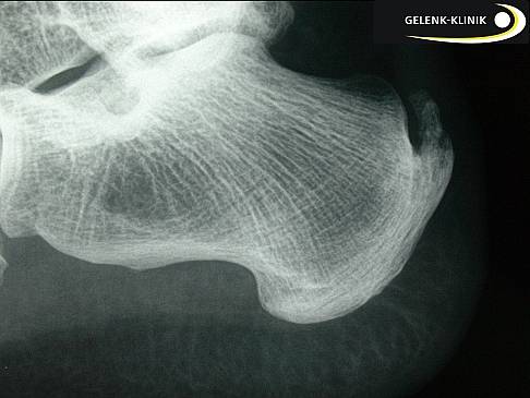 Haglundexostose mit oberem Fersensporn am Achillessehnenansatz