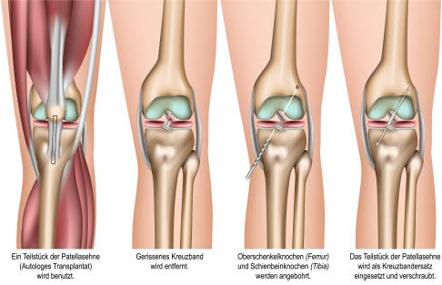Kreuzbandriss OP: Entnahme des Sehnentransplantats und Entfernen des gerissenen Kreuzbandes