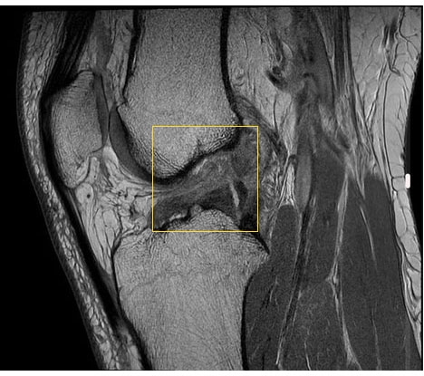 Vorderer Kreuzbandriss in der Kernspintomografie