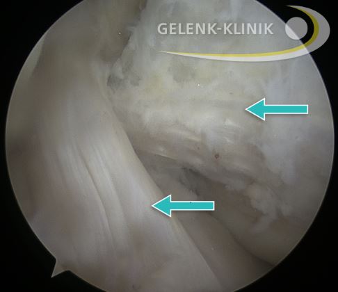 Kniegelenk: vorderes und hinteres Kreuzband