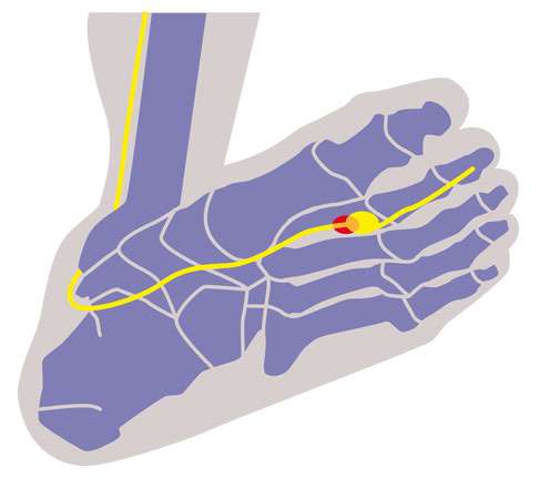 Morton Neurom: Metatarsalgie (Mittelfußschmerzen ...
