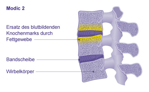 Klassifikation der Osteochondrose intervertebralis: Modic Typ 2