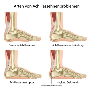 Achillodynie: Erkrankungen der Achillessehne