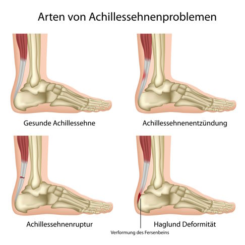 Erkrankungen der Achillessehne