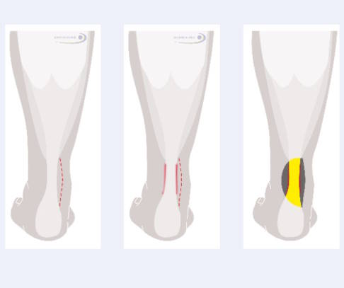 Behandlung der Sehnenhülle der Achillessehne in drei Schritten