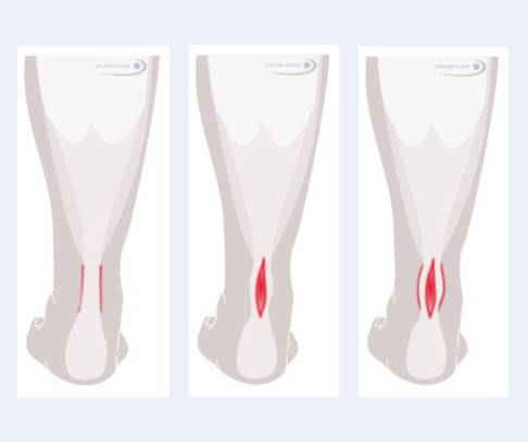 Grafische Darstellung in drei Bildern: Peritendinitis, isolierte Tendinosis und Peritendinitis mit Tendinosis.