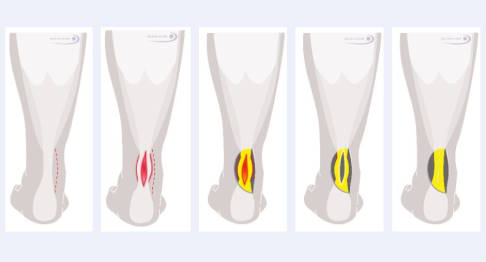 Sehnenausschneidung der Achillessehne in fünf Schritten