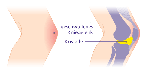 In den betroffenen Gelenken lagern sich Harnsäurekristalle ab und führen zu Entzündungen. © Gelenk-Klinik geschwollenes Kniegelenk durch Gicht