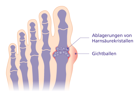 Ablagerung von Harnsäurekristallen im Großzehengrundgelenk