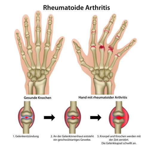 Rheumatoide Arthritis in den Fingergelenken