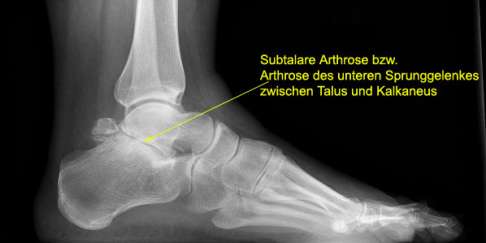 Röntgenbild Sprunggelenk