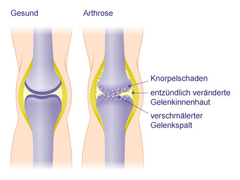 Degenerative Veränderungen bei Arthrose am Beispiel des Kniegelenks. Die schützende Knorpelschicht baut sich zwischen den Gelenkflächen von Oberschenkel und Unterschenkel ab und der Gelenkspalt verschmälert sich. Die Knochen berühren sich und reiben bei Bewegung direkt aufeinander. Hierdurch entstehen die starken Gelenkschmerzen bei Arthrose. © Gelenk-Klinik Schematische Darstellung eines gesunden und eines durch Arthrose veränderten Kniegelenks