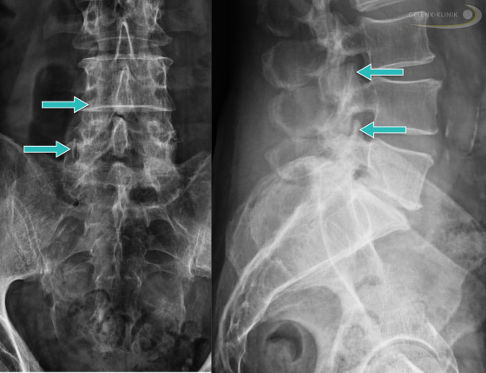 Arthrose der Wirbelgelenke im Röntgenbild