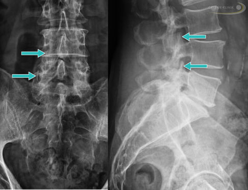 Spondylophyten