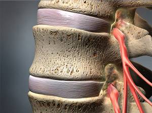 Лечение задних корешков спиномозговых нервов в позвоночном канале электродами PASHA®