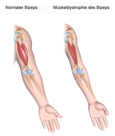 Vergleich Bizeps normal und Muskeldystrophie