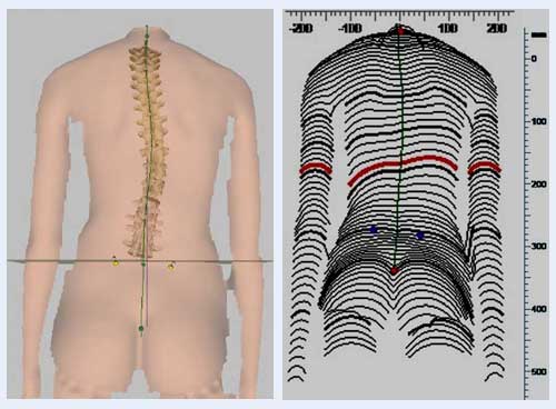 3D-Wirbelsäulenmessung beim Patienten