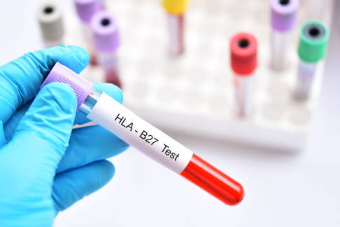 Blutprobe für die labordiagnostische Bestimmung des Genmerkmals HLA-B27
