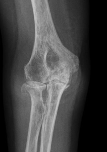 Ellenbogenarthrose im Röntgenbild