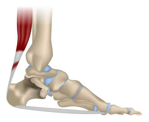 Achillobursitis (Entzündung des Schleimbeutels an der Achillessehne)