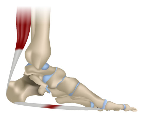 Plantarfasziitis (Plantarsehnenentzündung)