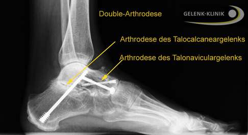 Röntgenbild des Fußes mit Double-Arthrodese