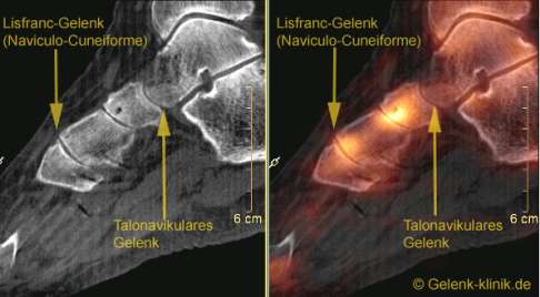 Untersuchung der Fußwurzelarthrose im SPECT-CT
