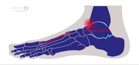 Impingement (Blockade) des Sprunggelenks