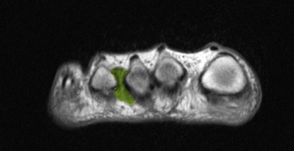 MRT (Magnetresonanztomografie): Aufnahme eines Morton Neuroms