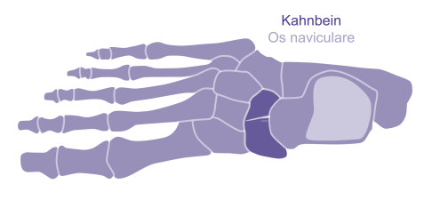 Stressfraktur Kahnbein