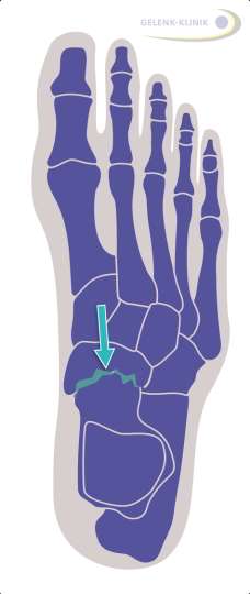 Eingezeichnet das Talonavikulare Gelenk zwischen Sprungbein (Talus) und Kahnbein (Os naviculare). Durch Operation des talonavikularen Gelenks kann das Fußlängsgewölbe wieder aufgerichtet werden.