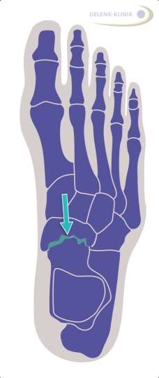 Gelenk zwischen Sprungbein und Kahnbein im Fuß
