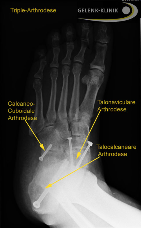 Röntgenbild der Triplearthrodese von oben gesehen © Gelenk-Klinik.de Triplearthrodese von Oben