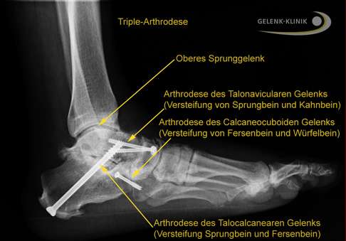 Röntgenbild der Triple-Arthrodese