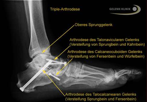 Röntgen: Triple-Arthrodese