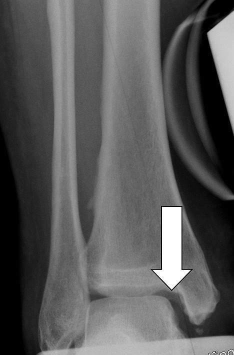 Defective position of the talar mortise resulting in an increased gap between the talus and tibia. The arrows show the missing congruency between the bones of the joint. Left untreated, this defective position of the talar mortise can result in arthritis of the ankle.